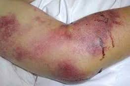 از شیوع بیماری تب‌کریمه کنگو جلوگیری می‌شود