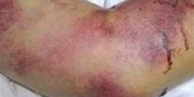 هشدار دامپزشکی درباره تب کنگو: جگر خام و نیمپز نخورید