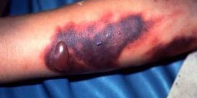 همه‌چیز درمورد تب کریمه کنگو