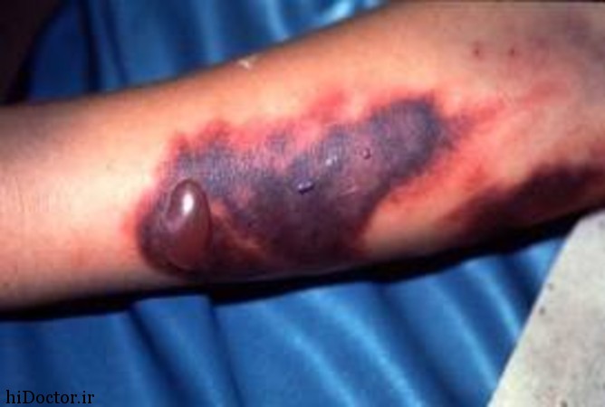 همه‌چیز درمورد تب کریمه کنگو