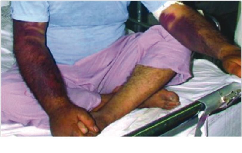 تب کریمه کنگو در گیلان مشاهده نشده است