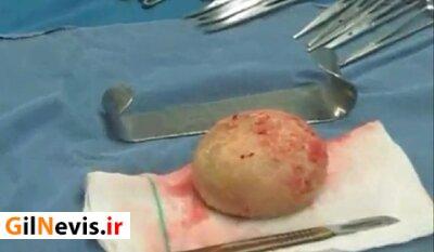 خارج کردن سنگ ۳۰۰ گرمی از مثانه مرد گیلانی
